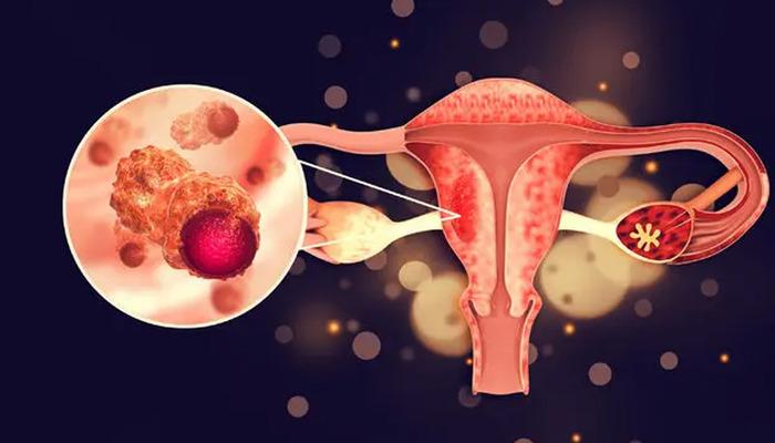 Yumurtalık kanserinde bu belirtilere dikkat! Kadınlarda en sık görülen 3’üncü kanser türü…