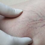 Yaz sıcakları varisleri tetikliyor